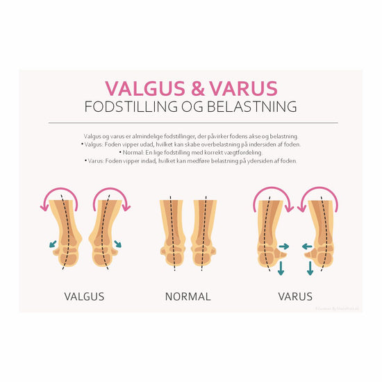 Valgus og Varus - Føddernes Anatomi